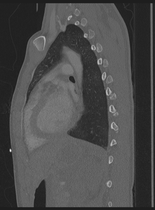 Abdominal multi-trauma - devascularised kidney and liver, spleen and pancreatic lacerations (Radiopaedia 34984-36486 Sagittal bone window 16).png