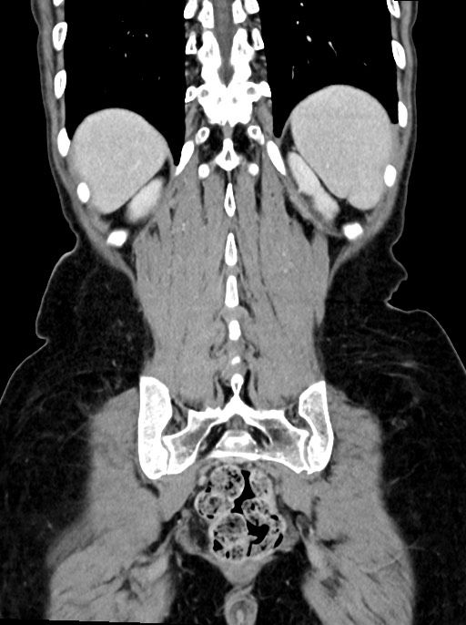 Abdominal wall and retroperitoneal tuberculosis (Radiopaedia 88137-104729 Coronal C+ portal venous phase 84).jpg