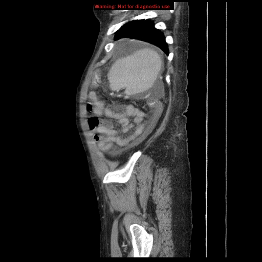 Abdominal wall hematoma (Radiopaedia 9427-10112 Sagittal C+ portal venous phase 18).jpg