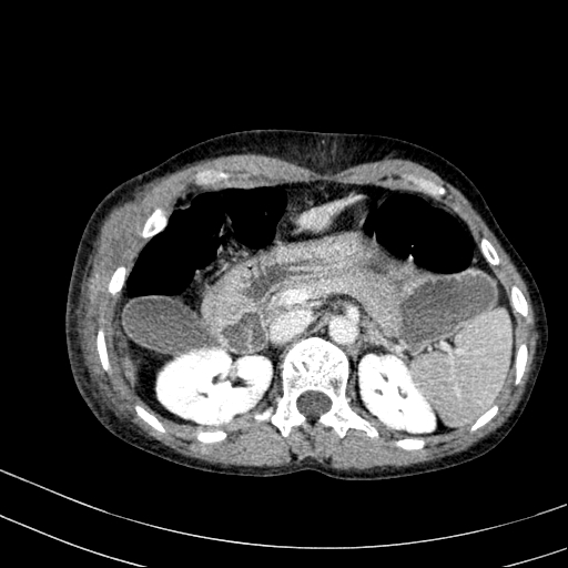 Abdominal wall hematoma with active bleeding (Radiopaedia 83915-99117 Axial C+ portal venous phase 9).jpg