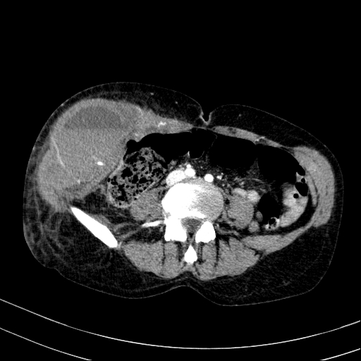 Abdominal wall hematoma with active bleeding (Radiopaedia 83915-99117 Axial renal cortical phase 69).jpg