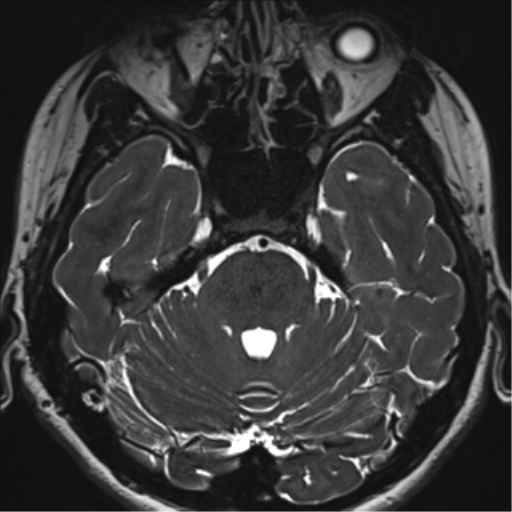 Abducens nerve palsy (Radiopaedia 51069-56648 Axial T2 fat sat 36).png