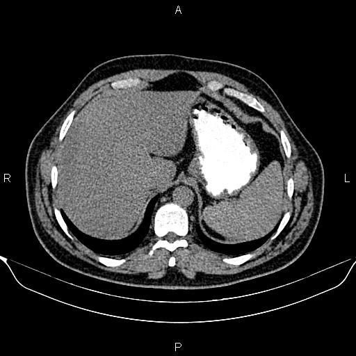 Aberrant right subclavian artery (Radiopaedia 87093-103354 Axial non-contrast 100).jpg