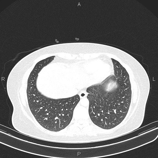 File:Aberrant right subclavian artery (Radiopaedia 87334-103629 Axial lung window 51).jpg