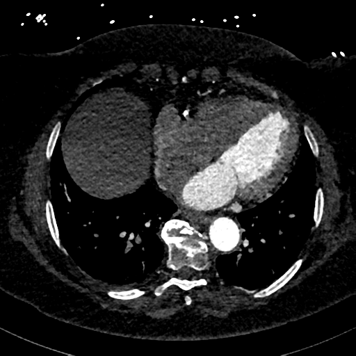 File:Aberrant right subclavian artery with Kommerell diverticulum (Radiopaedia 47982-52769 Axial C+ arterial phase 67).png