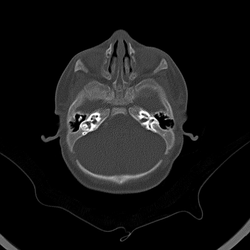 File:Accessory intraparietal suture (Radiopaedia 50584-56020 Axial bone window 6).jpg