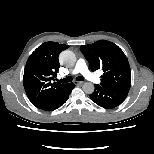 Accessory left horizontal fissure with lingular pneumonia (Radiopaedia 53763-59843 Axial C+ CTPA 40).jpg