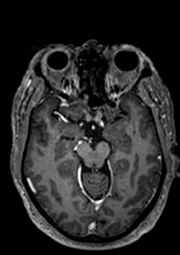 Accessory middle cerebral artery (Radiopaedia 73114-83828 Axial T1 C+ 76).jpg