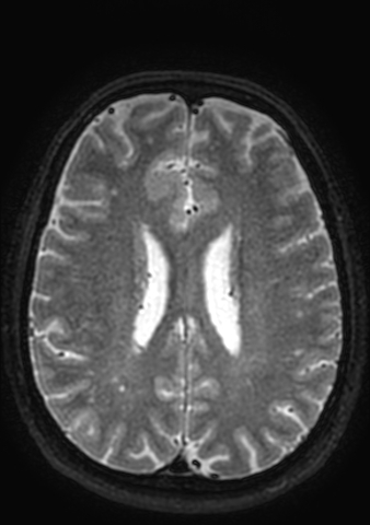 Accessory middle cerebral artery (Radiopaedia 73114-83828 Axial T2 21).jpg