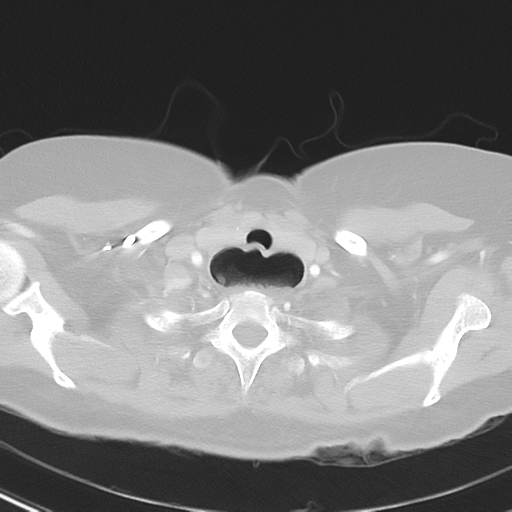 File:Achalasia (Radiopaedia 47147-51685 Axial lung window 4).png