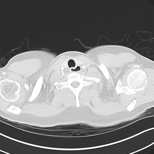 File:Achalasia of the cardia (Radiopaedia 38497-40595 Axial lung window 2).png