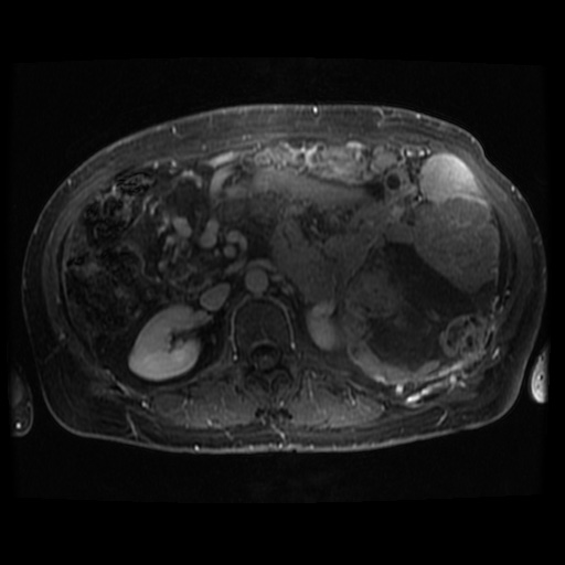 Acinar cell carcinoma of the pancreas (Radiopaedia 75442-86668 Axial T1 C+ fat sat 44).jpg