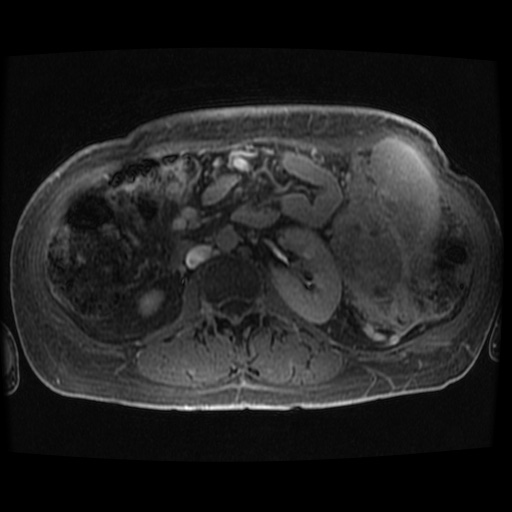Acinar cell carcinoma of the pancreas (Radiopaedia 75442-86668 Axial late phase (~30 mins) 21).jpg