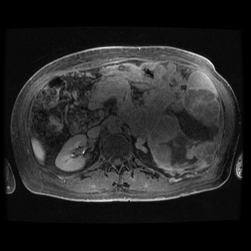 Acinar cell carcinoma of the pancreas (Radiopaedia 75442-86668 Axial late phase (~30 mins) 48).jpg