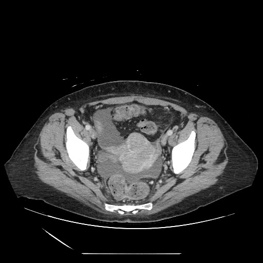 Acinar cell carcinoma of the pancreas (Radiopaedia 75442-86669 Axial C+ portal venous phase 128).jpg