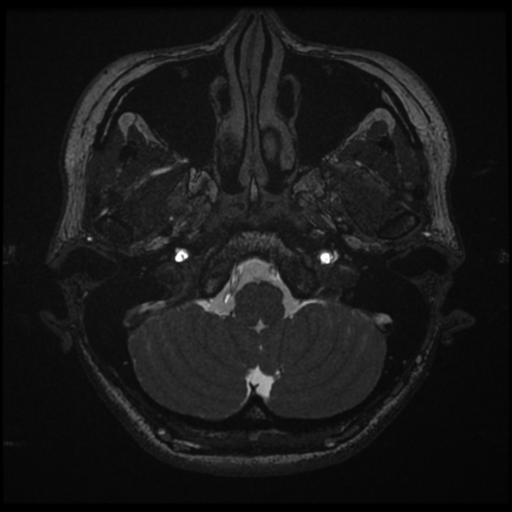 Acoustic neuroma (Radiopaedia 34049-35283 Axial 17).png