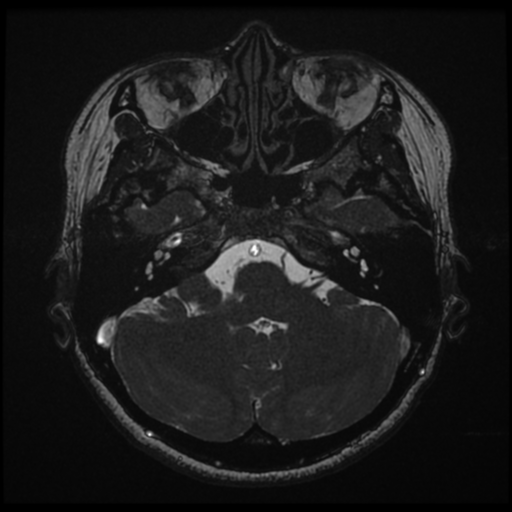 Acoustic neuroma (Radiopaedia 34049-35283 Axial 46).png