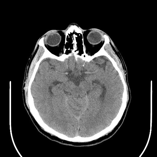 File:Acoustic schwannoma (Radiopaedia 29488-29982 AXIAL THICK non-contrast 20).jpg