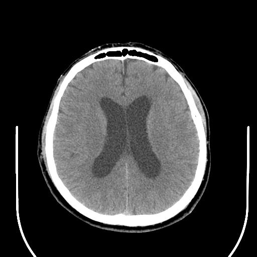 File:Acoustic schwannoma (Radiopaedia 29488-29982 AXIAL THICK non-contrast 30).jpg