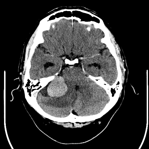 File:Acoustic schwannoma (Radiopaedia 39170-41389 Axial C+ 8).png