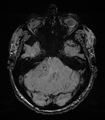 Acoustic schwannoma (Radiopaedia 50846-56358 Axial SWI 26).png