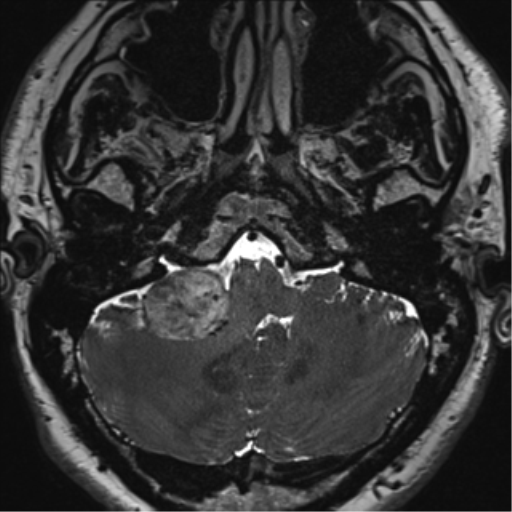 File:Acoustic schwannoma (Radiopaedia 50846-56358 Axial T2 12).png