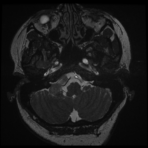 Acoustic schwannoma (Radiopaedia 57574-64536 Axial T2 13).png