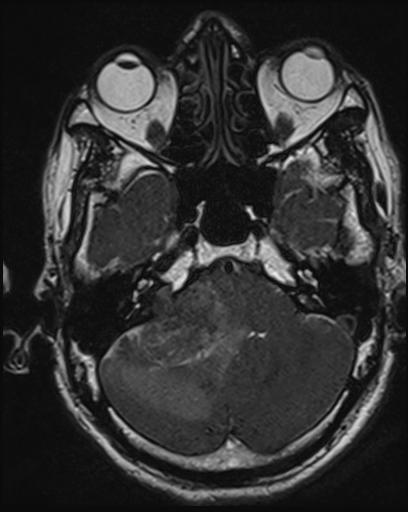 File:Acoustic schwannoma - probable (Radiopaedia 20386-20292 Axial T1 35).jpg