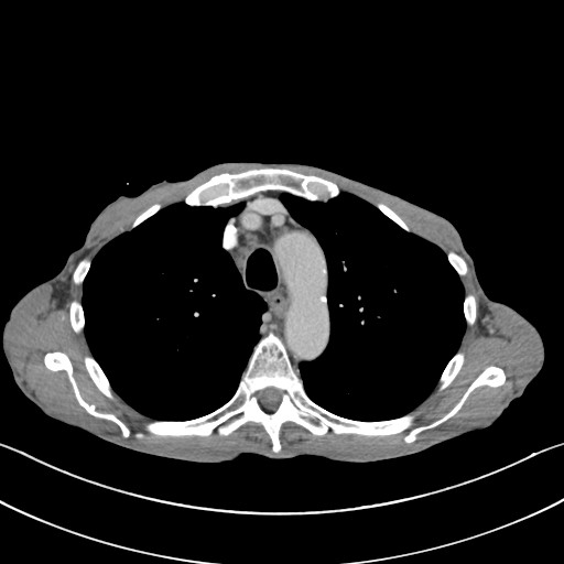 File:Acquired tracheoesophageal fistula (Radiopaedia 57747-65042 Axial C+ portal venous phase 27).jpg