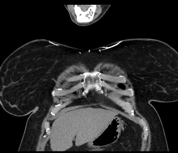 Acromioclavicular joint cyst (Radiopaedia 58455-65610 Coronal C+ arterial phase 31).jpg