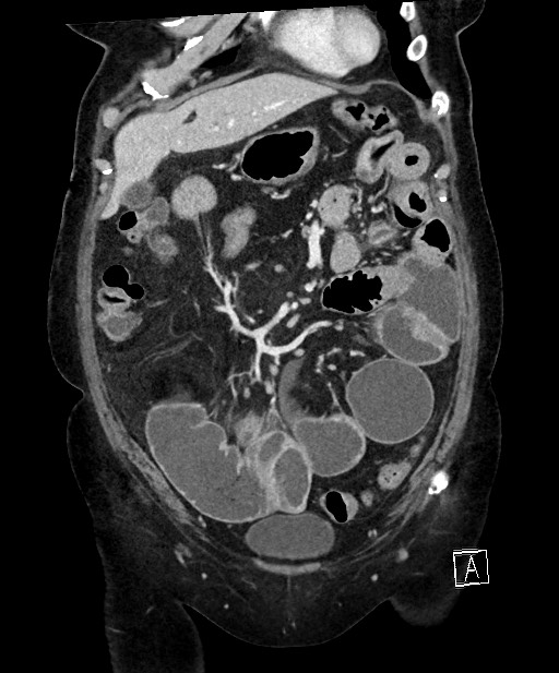 Active Crohn disease (Radiopaedia 59394-66750 Coronal C+ portal venous phase 24).jpg