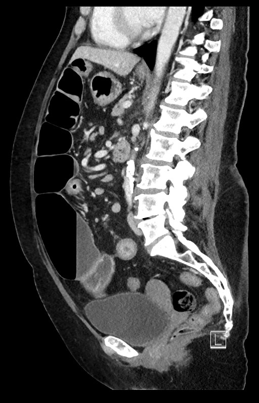 Active Crohn disease (Radiopaedia 59394-66750 Sagittal C+ portal venous phase 26).jpg