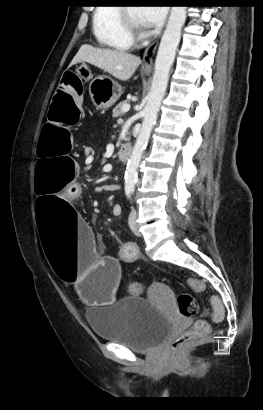 Active Crohn disease (Radiopaedia 59394-66750 Sagittal C+ portal venous phase 27).jpg