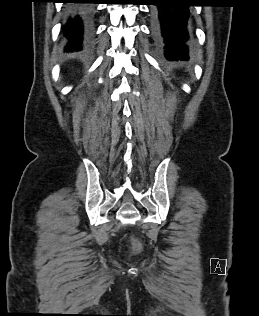 Active lower gastrointestinal bleeding - diverticular (Radiopaedia 61203-69106 Coronal C+ portal venous phase 115).jpg