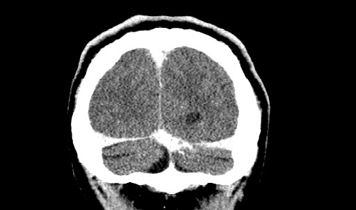 File:Active neurocysticercosis before and after therapy (Radiopaedia 71710-82099 Coronal 48).jpg