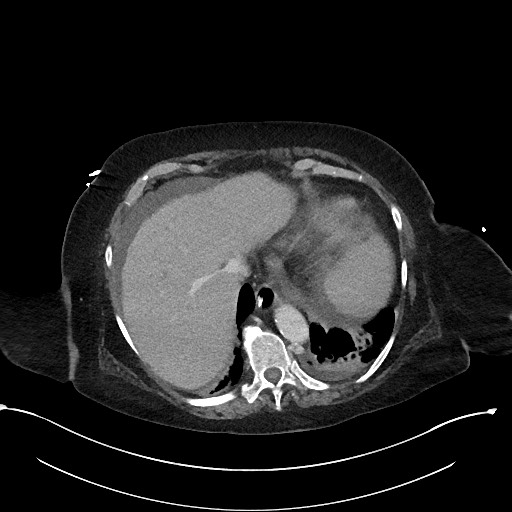 File:Active renal extravasation with large subcapsular and retroperitoneal hemorrhage (Radiopaedia 60975-68796 Axial 331).jpg
