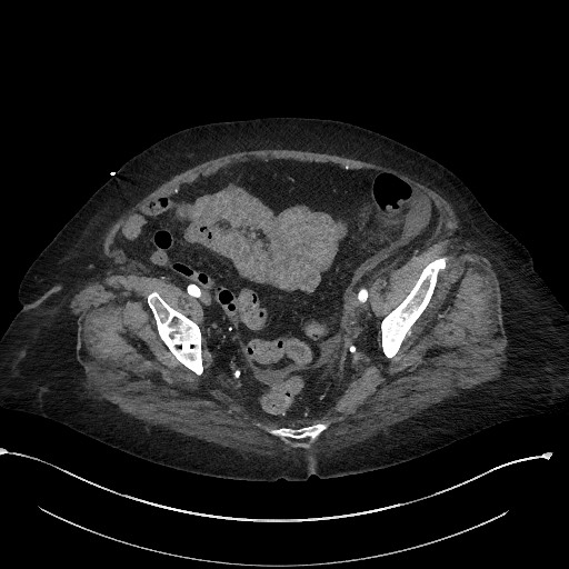 Active renal extravasation with large subcapsular and retroperitoneal hemorrhage (Radiopaedia 60975-68796 Axial C+ arterial phase 165).jpg