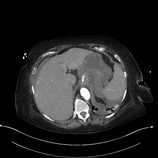 Active renal extravasation with large subcapsular and retroperitoneal hemorrhage (Radiopaedia 60975-68796 Axial C+ arterial phase 40).jpg