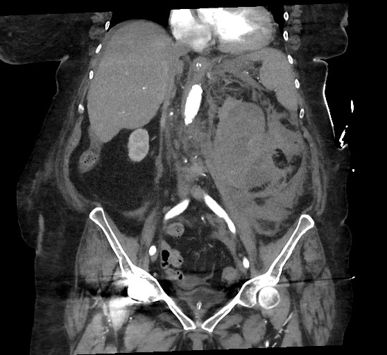Active renal extravasation with large subcapsular and retroperitoneal hemorrhage (Radiopaedia 60975-68796 Coronal C+ arterial phase 82).jpg