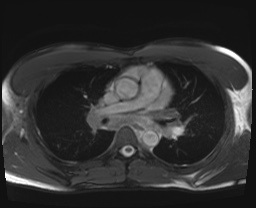 File:Active right ventricular cardiac sarcoidosis (Radiopaedia 55596-62100 Axial SSFP 14).jpg