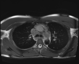 File:Active right ventricular cardiac sarcoidosis (Radiopaedia 55596-62100 Axial SSFP 17).jpg