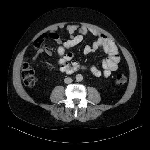 Acute-on-chronic pancreatitis (Radiopaedia 67286-76656 Axial C+ portal venous phase 45).jpg