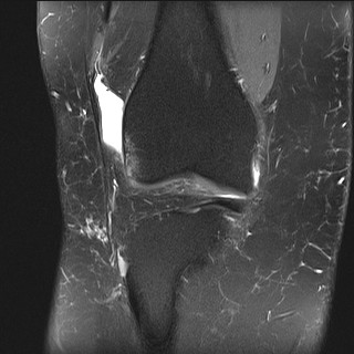 File:Acute-on-chronic transient lateral patellar dislocation with trochlear dysplasia (Radiopaedia 84099-99349 Coronal PD fat sat 26).jpg