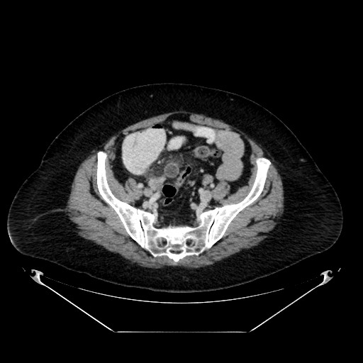 Acute appendicitis, heterotaxy syndrome (Radiopaedia 66884-76202 Axial C+ portal venous phase 100).jpg