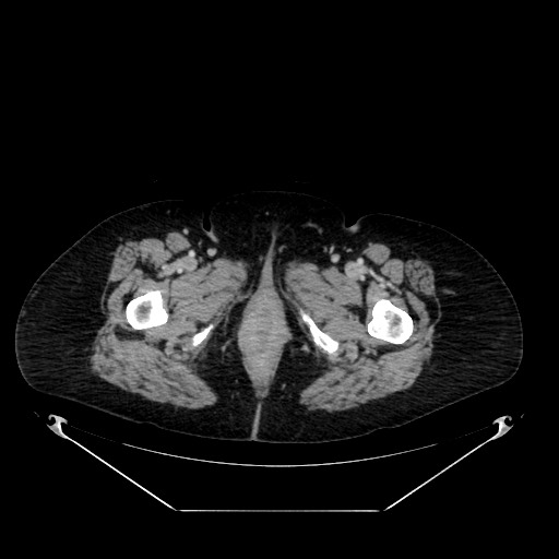 Acute appendicitis, heterotaxy syndrome (Radiopaedia 66884-76202 Axial C+ portal venous phase 140).jpg