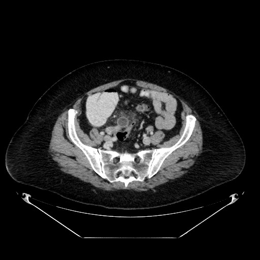Acute appendicitis, heterotaxy syndrome (Radiopaedia 66884-76202 Axial C+ portal venous phase 98).jpg