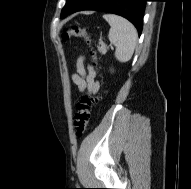 Acute appendicitis (Radiopaedia 38255-40270 Sagittal C+ portal venous phase 67).jpg