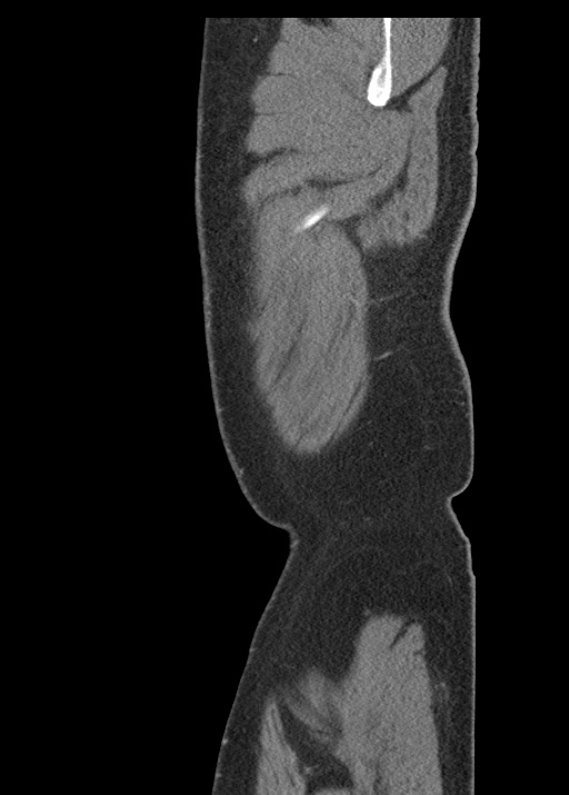 Acute appendicitis (Radiopaedia 48511-53463 Sagittal C+ portal venous phase 16).jpg