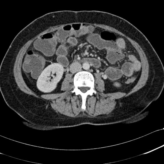 Acute appendicitis (Radiopaedia 48792-53822 Axial C+ portal venous phase 60).jpg