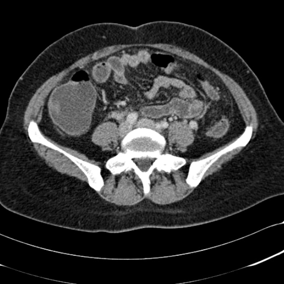 File:Acute appendicitis (Radiopaedia 48792-53822 Axial C+ portal venous phase 75).jpg